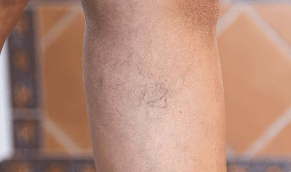 What Causes Spider Veins On Legs Coastal Vascular And Interventional 9678