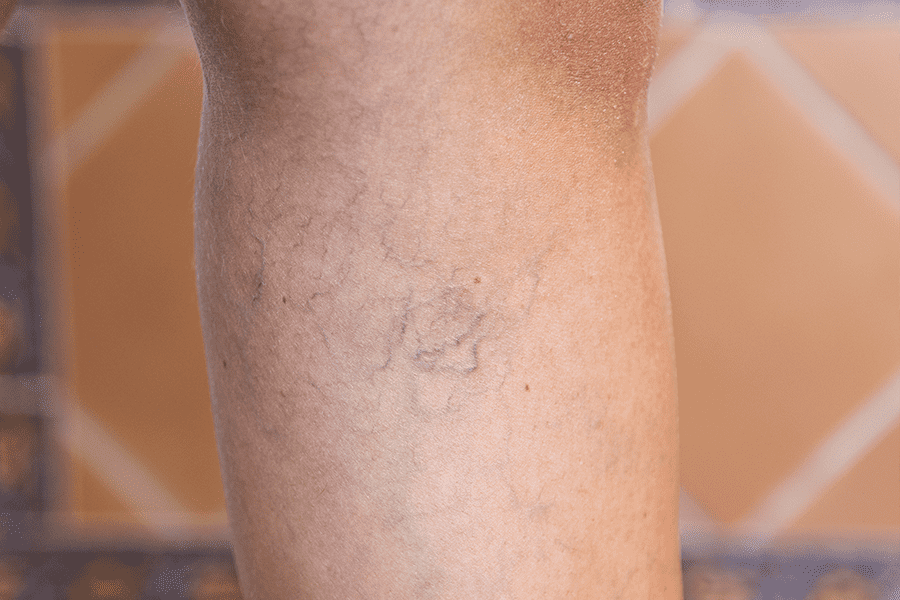 Image of patient leg before specialists at Coastal Vascular begin a Treatment for Varicose Veins