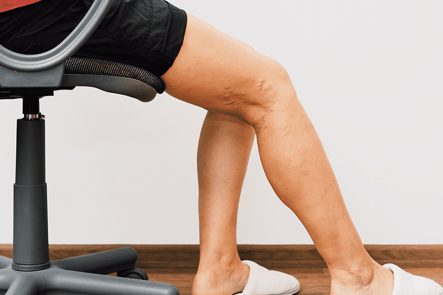 Patient sits on office chair at Coast Vascular & Interventional to examine varicose veins