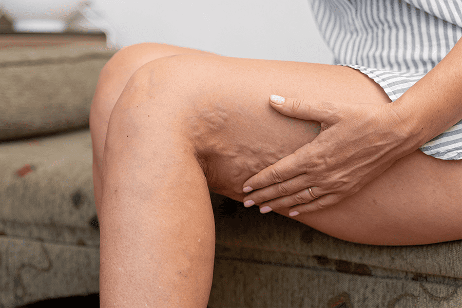 Patient examines legs to determine if she needs Treatment for Varicose Veins